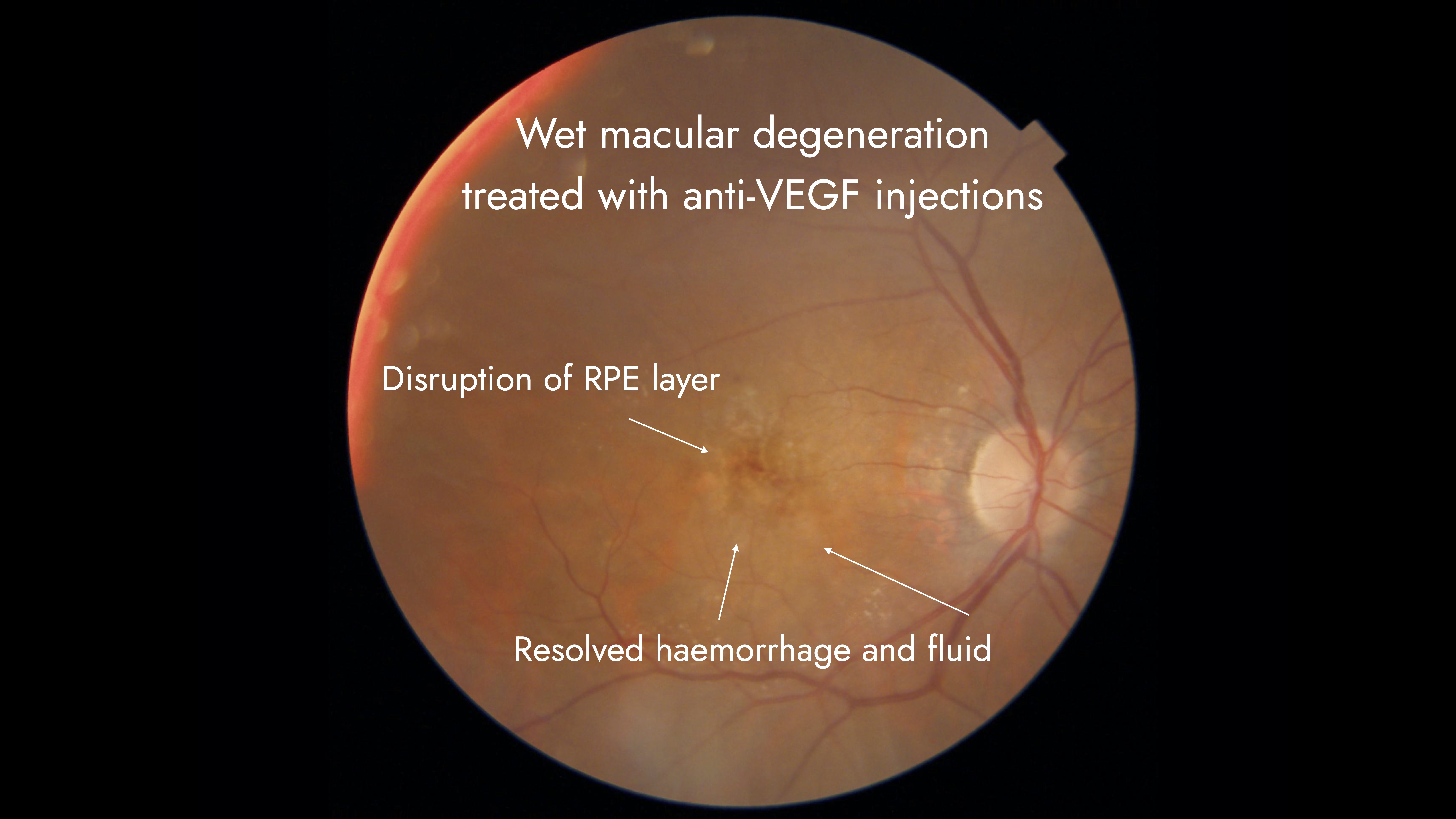 AntiVEGF intravitreal injection